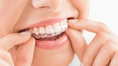 تجربتي مع تقويم الأسنان الشفاف