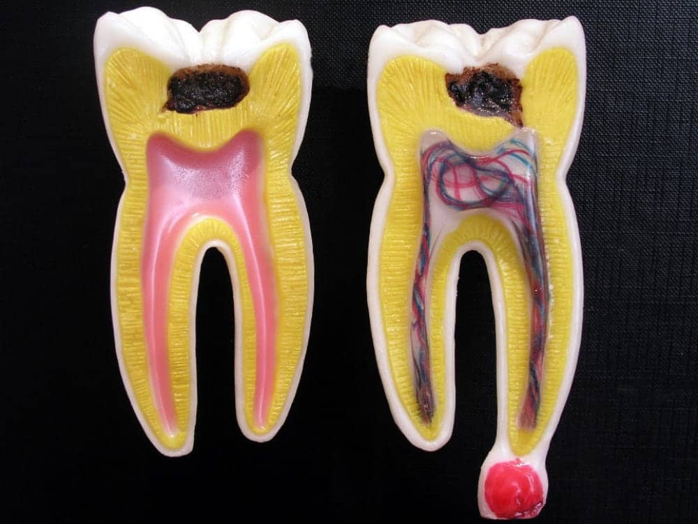 علاج خراج الأسنان بالثوم