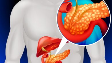 متلازمة زولينجر إليسون