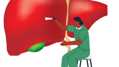 عملية زراعة الكبد