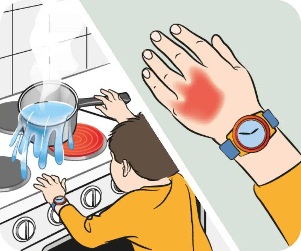 الإسعافات الأولية للأطفال عند الحرق