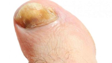 فطريات الأظافر