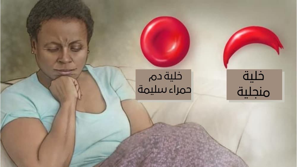 الانيميا المنجلية مرض فقر الدم