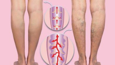 دوالي الساقين