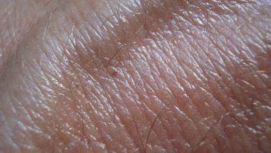 سرطان الجلد