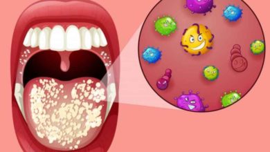 فطريات الفم عند الأطفال