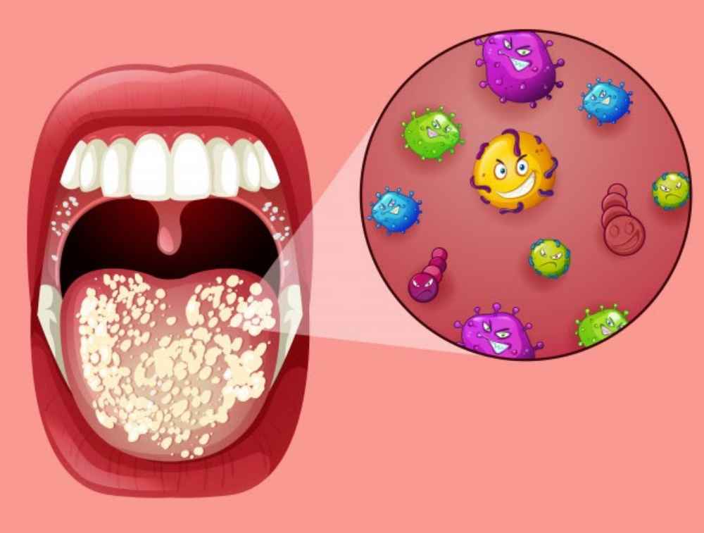 فطريات الفم عند الأطفال