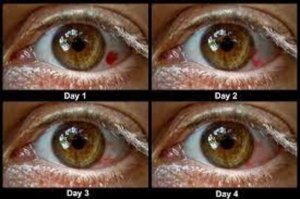 مراحل جلطة العين
