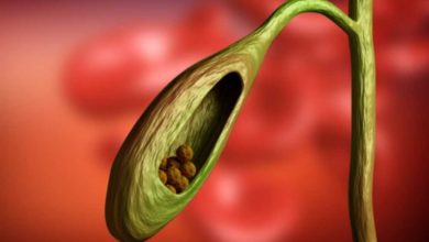 الحصوات المرارية