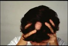 علاج الثعلبة