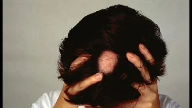 علاج الثعلبة