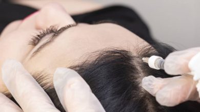 علاج-الصلع-الوراثي