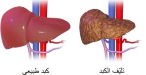 مراحل تليف الكبد 