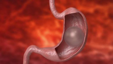 عملية-بالون-المعدة