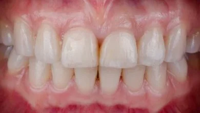أسباب-الابتسامة-اللثوية-