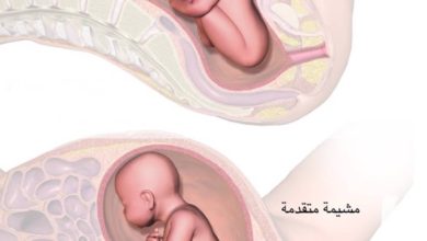 متى ترجع المشيمة المتقدمة لوضعها الطبيعي