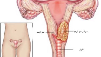 سرطان-عنق-الرحم-min