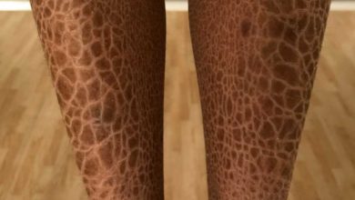 مرض السمكية الجلدية