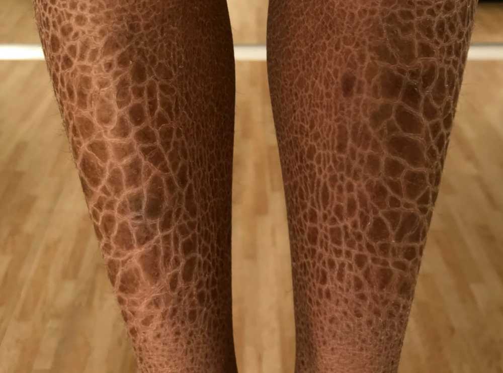 مرض السمكية الجلدي