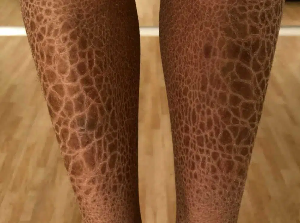 مرض السمكية الجلدي