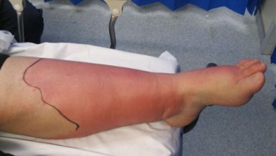 الالتهاب الخلوي