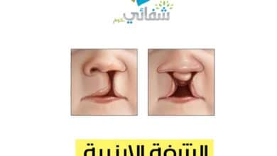 الشفة الأرنبية