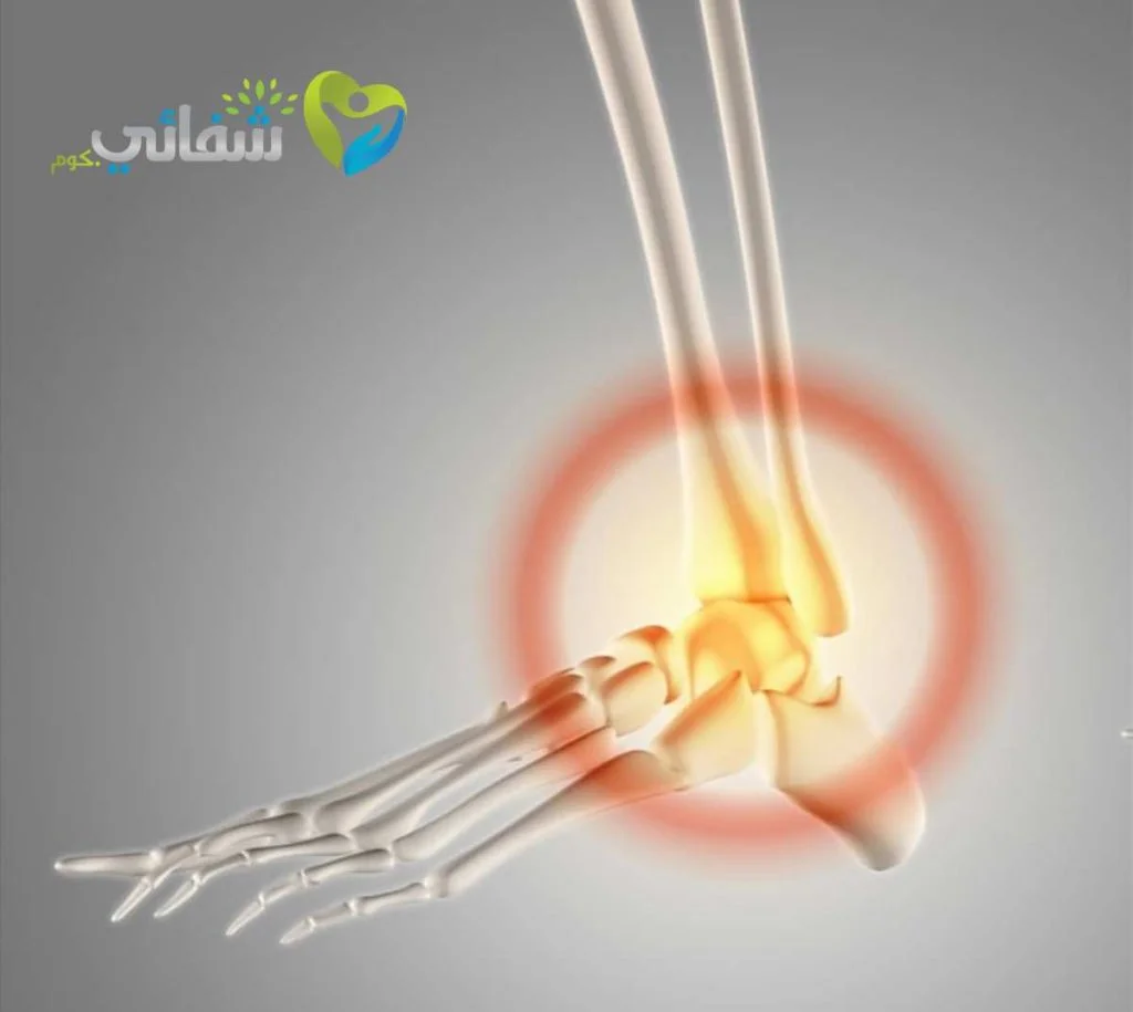 الفرق بين الشوكة العظمية والتهاب اللفافة الأخمصية