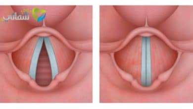 لحمية الأحبال الصوتية