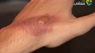 تغذية مرضى الحروق