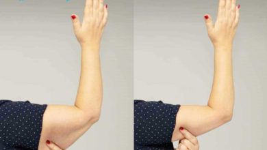 أنواع عمليات شد ترهلات الذراعين