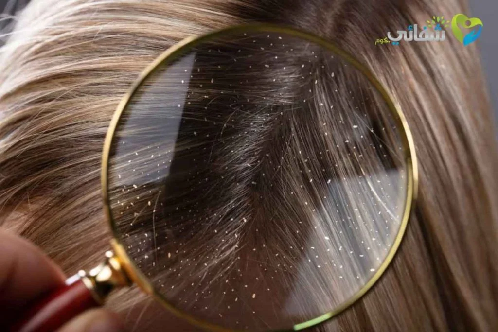 تجربتي مع نيزورال شامبو للقشرة