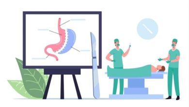 تجربتي مع تحويل المسار بعد التكميم