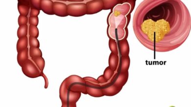 تجربتي-مع-سرطان-القولون